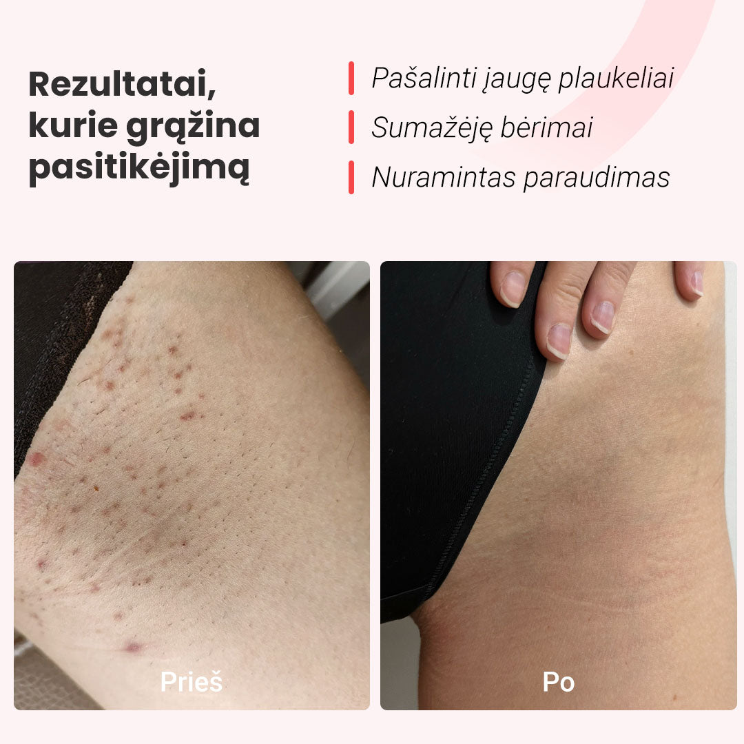 IPL fotoepiliatorius